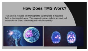 How does TMS work